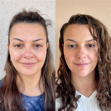 2 Week Update Chin And Cheek Filler Masseter Botox And Lip Flip— Love My New Heart Shaped Face