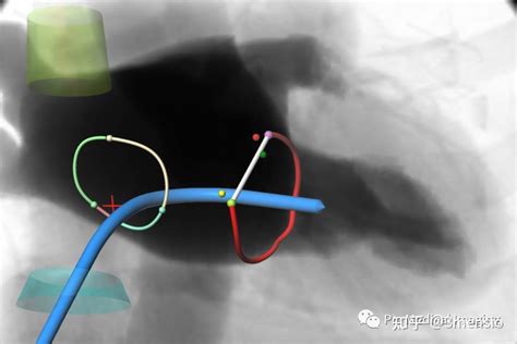 3mensio Mitral 知乎