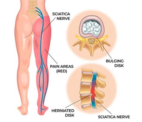 Sciatica Pain