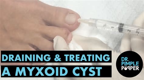 Draining And Treating A Myxoid Cyst Dr Pimple Popper