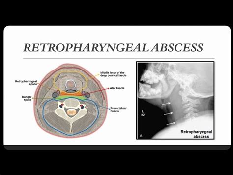 Retropharyngeal Abscess Diagram