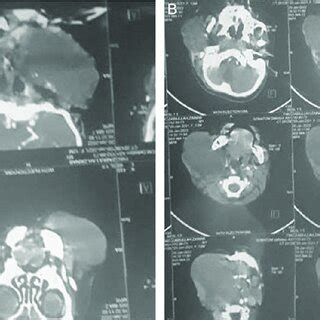 A And B Computed Tomography Scan Images Of The Lesion Revealing The