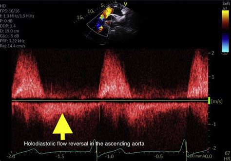 Two Dimensional Transthoracic Echocardiographic Suprasternal View With