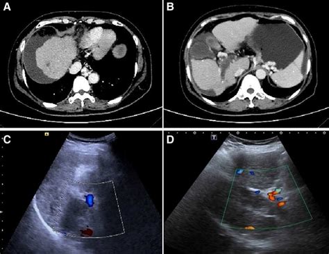 Preoperative Abdominal CT And Color Ultrasound Examination A