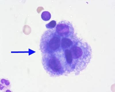 Synovial Cell Sarcoma Cancer – Symptoms, Survival Rate, Prognosis ...