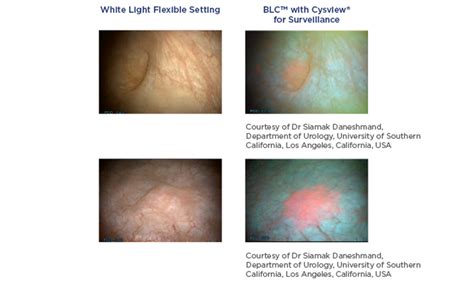 Blue Light Cystoscopy Cost | Shelly Lighting