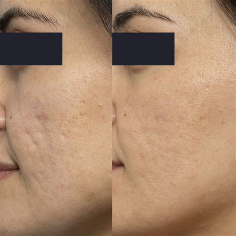 Acne Dark Spots Before And After