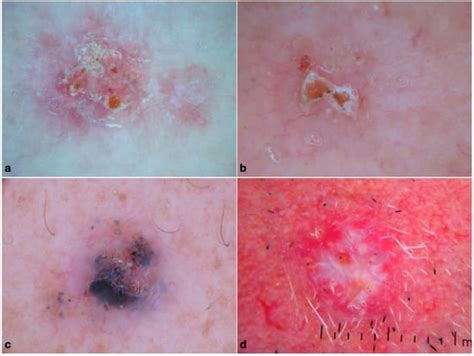 Dermoscopic Clues Of Histopathologically Aggressive Basal Cell