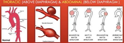 Aortic Aneurysms And Aortic Dissection Flashcards Quizlet