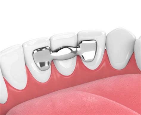 Qué Es Un Puente Dental Tipos Y Características Clinica Dental Oris