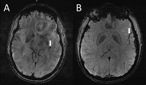 Migraine Brain Changes - Neuroscience News