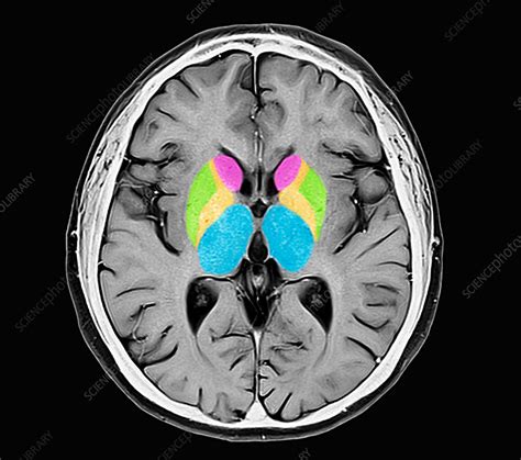 Human brain, MRI scan - Stock Image - C037/2999 - Science Photo Library