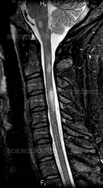 Multiple Sclerosis of Cervical Spinal | Stock Image - Science Source Images