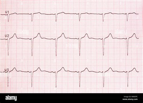 Electrocardiogram graph on paper Stock Photo - Alamy