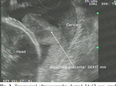 Placental Abruption Ultrasound