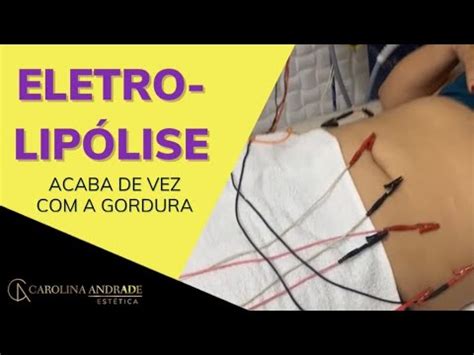 Acabar De Vez A Gordura Localizada A Eletrolip Lise Youtube