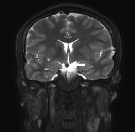 A Sagittal T1 Weighted Mri B Axial T2 Gradient Mri C Axial