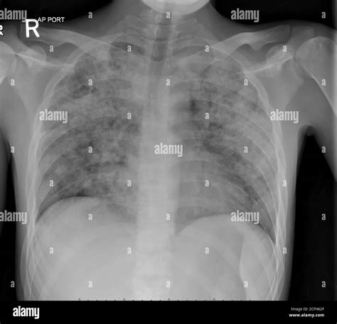 Pulmonary Tuberculosis Chest X Ray