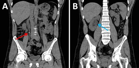 Struvite Kidney Stones Xray