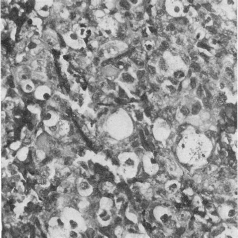 -Histology of undifferentiated angiosarcoma (lung metastasis). H.E. x ...