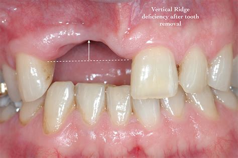 Periodontal Disease And Bone Loss Case Study Shaun Portland Perio