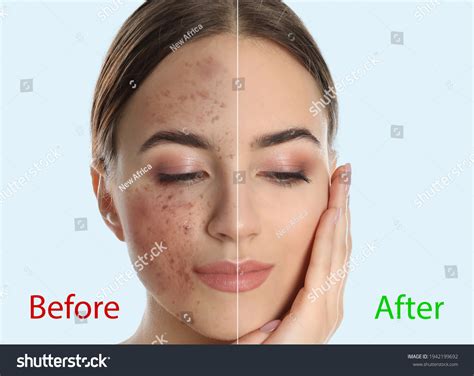 Young Woman Before After Cosmetic Procedure Stock Photo 1942199692 ...