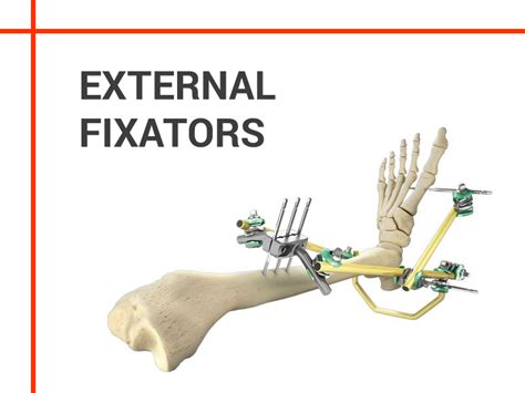 External Fixators Advantages And Disadvantages Consopharma