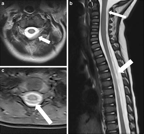 Abusive Head Trauma In A Month Old Boy With Multiple Bruises Diffuse