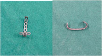 Frontiers Efficacy Comparison Of Kirschner Wire Tension Band Combined