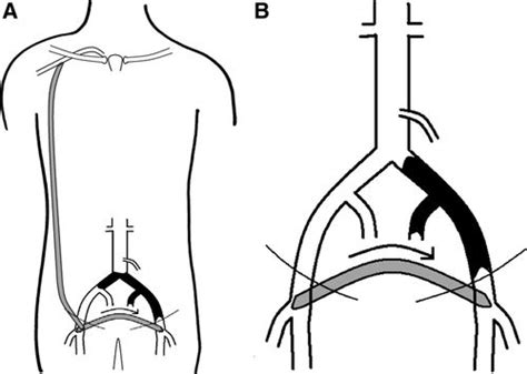 Surgical Technique And Peripheral Artery Disease Circulation