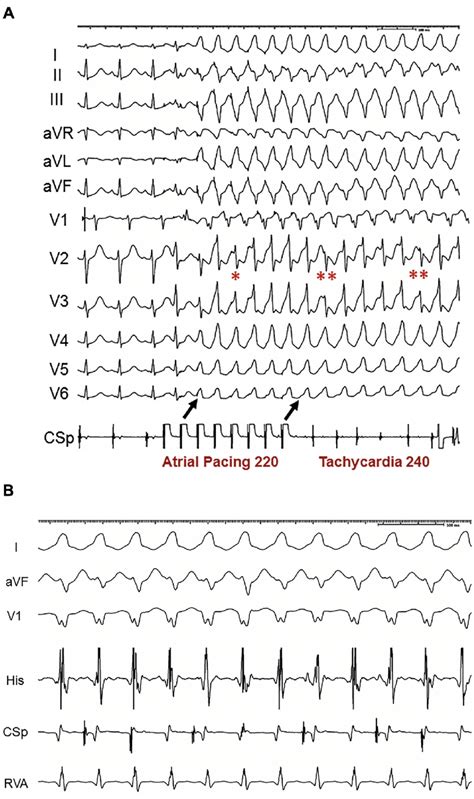 A Initiation Of Wide Complex Tachycardia With Atrial Pacing The Download Scientific Diagram