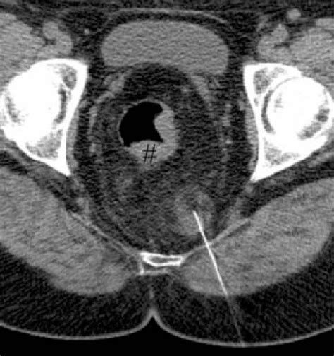 Figure From Presacral Myelolipoma In A Patient With Rectal Cancer