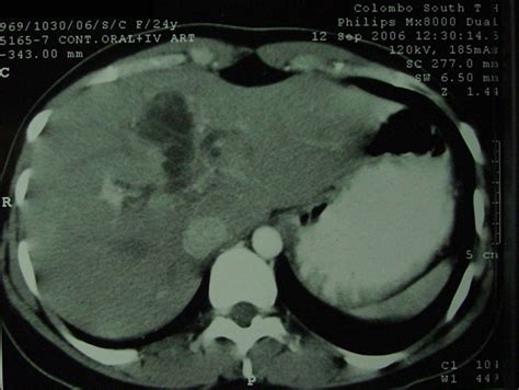 Episodic Biliary Obstruction Due To An Intrahepatic Biliary Cystadenoma