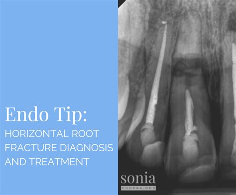 Horizontal Root Fracture Diagnosis And Treatment Sonia Chopra Dds