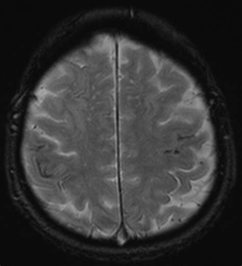 Cerebral Amyloid Angiopathy Amyloid Spells And Cortical Superficial