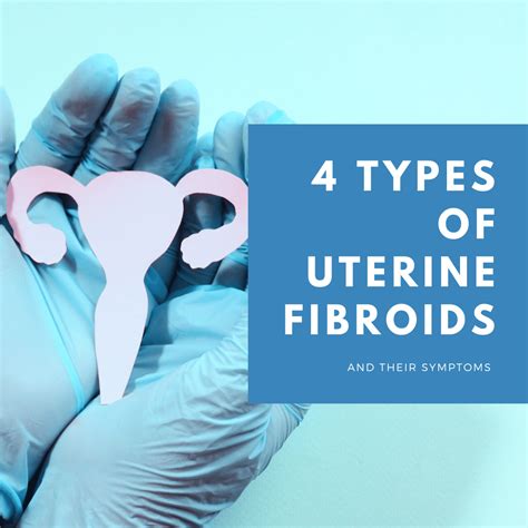 4 Types Of Uterine Fibroids And Their Symptoms New York City 1