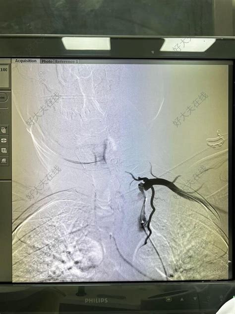锁骨下动脉盗血综合征 好大夫在线