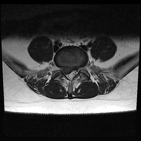 MRI of the Lower Back | Melbourne Radiology