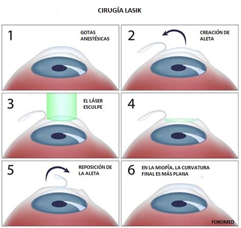 Cirug A Lasik En Qu Consiste Y C Mo Prepararse