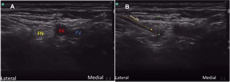 Femoral Nerve Block A Fn Femoral Nerve Fa Femoral Artery Fv