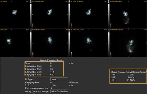 Imaging Review Of Gastrointestinal Motility Disorders RadioGraphics