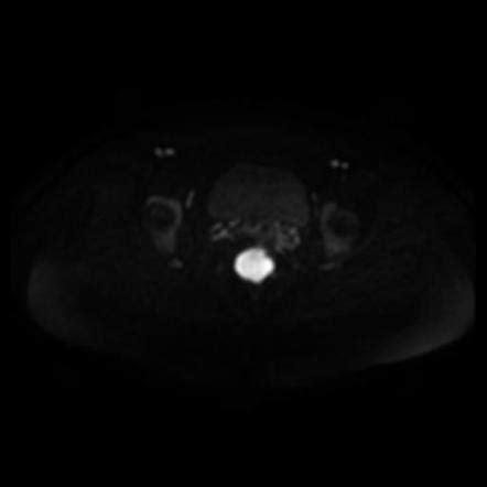 Tailgut Duplication Cyst Image Radiopaedia Org