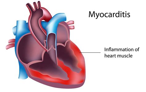 What To Know About Heart Viral Infection Symptoms Causes Treatment