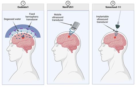 Focused Ultrasound For The Treatment Of Brain Tumors Encyclopedia Mdpi