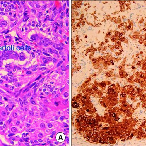 A Sertoli Cells Surrounded By Leydig Cells Hande ×60 B