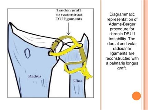 Distal Radioulnar Joint Injuries