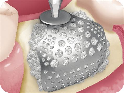 Osstem Implant