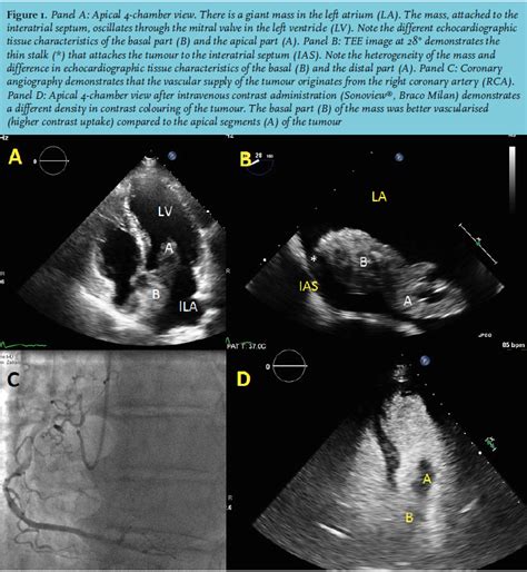 Article Intracardiac Masses Utility Of Contrast Enhanced