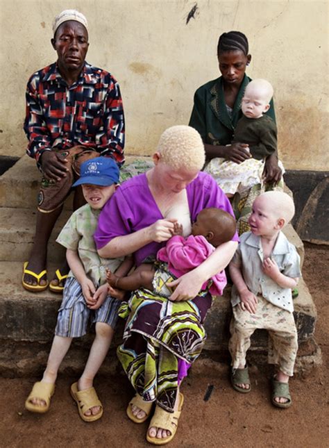 Rr Celebrating Diversity Albino Twins Born To A Black Mother Embrace