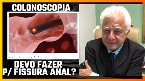 Série Fissura Anal É Certo Fazer Colonoscopia Diagnóstico Fissura Anal